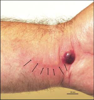 Figure 3: An extreme case of reaction to bed bug bites