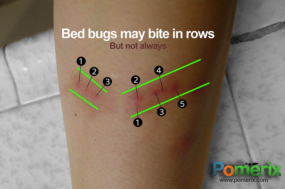 Bed Bug Bite Identification And Differentiation